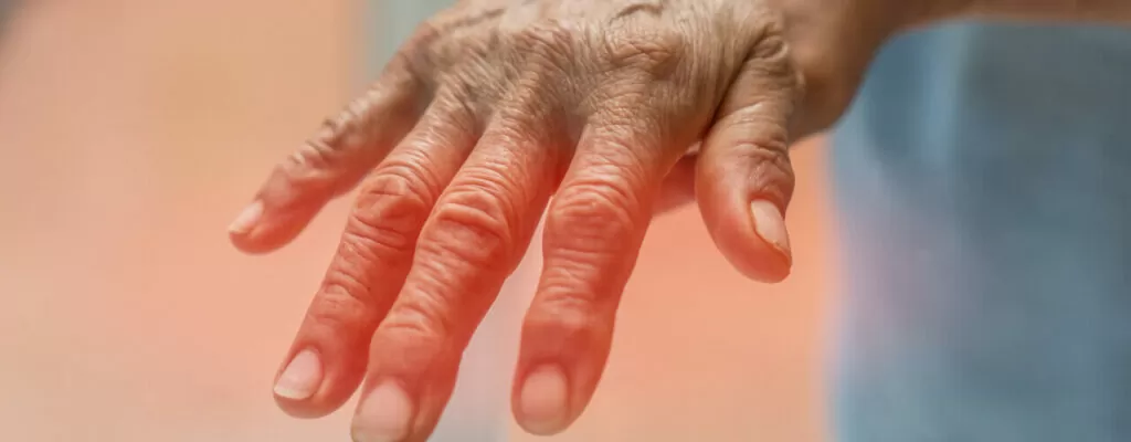 Arthritis