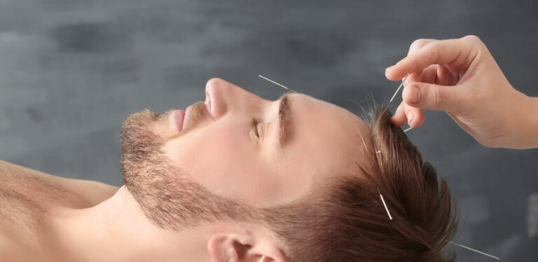 How_Acupuncture_Can_Help_Relieve_Headaches.