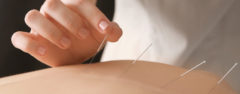 The_Benefits_Of_Acupuncture