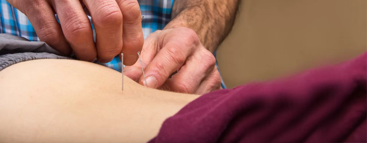 Dry Needling